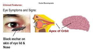 Fungus Infection of Eye and Orbit fungusinfectionofeye mucornycosis zygomycosis phycomycosis [upl. by Erdman142]