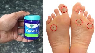 MAGIC VICKS VAPORUB  How To Remove Foot Corn Or Callus At Home MAGIC INGREDIENTS  OVERNIGHT [upl. by Bust261]