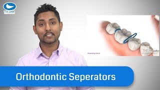 Orthodontic SeparatorsSpacers  What they are and TIPS [upl. by Valeria655]