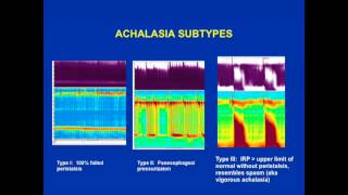 Achalasia is the esophageal motility abnormality [upl. by Lim]