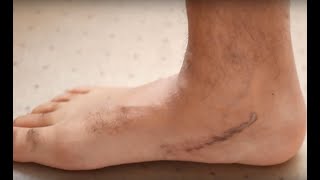 1 Year Update After My Flat Foot Reconstruction Surgery [upl. by Aicilram]