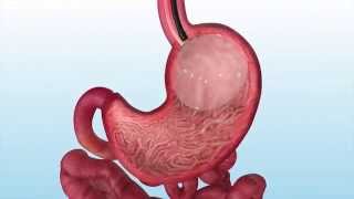 How is the Gastric Balloon Inserted and Removed [upl. by Kerman]