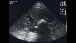 Sonography of the Gallbladder and Bile Ducts [upl. by Catherine158]