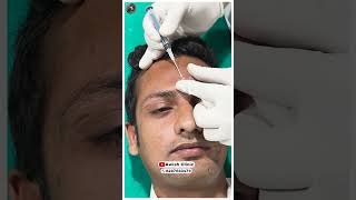 Unbelievable Skin Transformation After Subcision Treatment Awish clinic [upl. by Ytsud207]