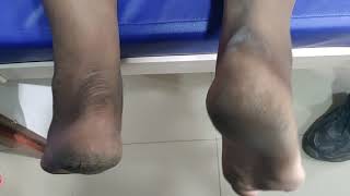 Simmonds test  Thompson test  SimmondsThompson test  rupture of the Achilles tendon [upl. by Sherourd]