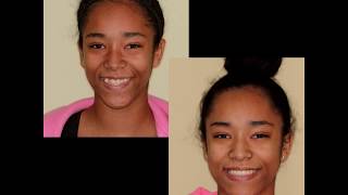 Underbite Correction in an Adolescent with Traditional Braces [upl. by Krystyna991]