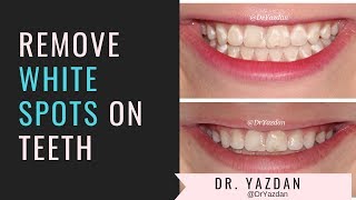 How To Remove White Spots On Teeth  Icon Dental Treatment  Dr Yazdan [upl. by Semela]