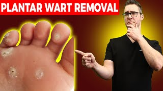 1 BEST Plantar Wart Removal How To Get Rid of Warts Treatments [upl. by Jacobsen]