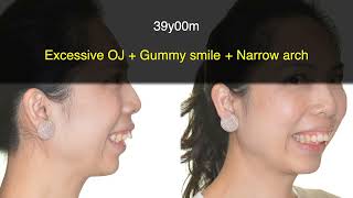 Excessive Overjet and Gummy Smile Treated with Clear Aligners｜【Chris Chang Ortho】CC671 [upl. by Ginger]