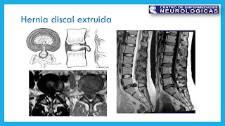 Hernia de disco intervertebral II [upl. by Gio]