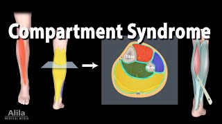 Compartment Syndrome Animation [upl. by Serrell822]