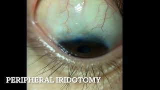 Peripheral Iridotomy [upl. by Klatt]