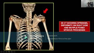 CTBUZZ2023Sourav Routray Radiological Manifestations of Klippel Feil Syndrome [upl. by Atlas694]