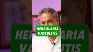 Herbolaria para vasculitis salud herbolaria homeopatia vasculitis varices [upl. by Pittman]