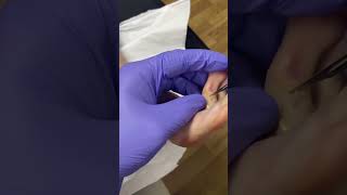 Watch an Aussie podiatrist tackle a troublesome toe corn CornRemoval PodiatryDownUnder [upl. by Polk]