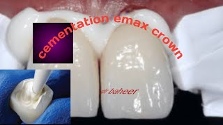 cementation to emax crown or emax veneer or indirect composite crowndental crown [upl. by Bork509]