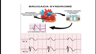 Brugada Syndrome  ECG Changes in Brugada Syndrome  Brugada Sign  Symptom and Signs in Brugada [upl. by Glenna]