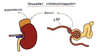 Hyperaldosteronism and Conns Syndrome [upl. by Nlycaj]