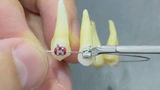 Self ligating braces VS Traditional for both types metal braces amp ceramicbraces damonbraces [upl. by Spiegel523]