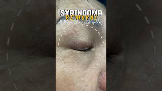 Syringoma treatment drlyna syringoma eccringland klinikdrlyna lasertreatments [upl. by Basilius]