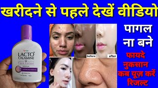 lacto calamine face lotion honest review 2023 benefitsside effectsopen pores treatment in 7 days [upl. by Hackney]