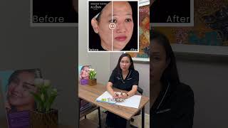 Melasma Explained Causes Symptoms and Treatment Expectations [upl. by Siri]