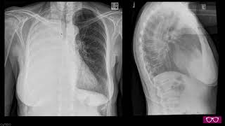 Getting to the bottom of whiteout  Reading CXR for radiology viva exams [upl. by Aisak632]