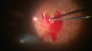 Vitrectomy for Subhyaloid haemorrhage in Diabetic Retinopathy  Dr Manish Nagpal [upl. by Magena]