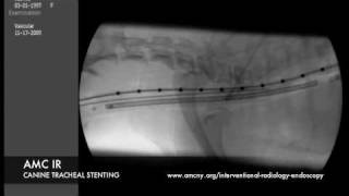 Interventional Radiology Tracheal Stent [upl. by Orelie]