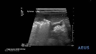 Pyloric Stenosis NLS Video [upl. by Beata]