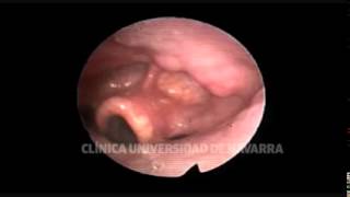 DISE Colapso paredes laterales epiglotis en omega [upl. by Giannini372]