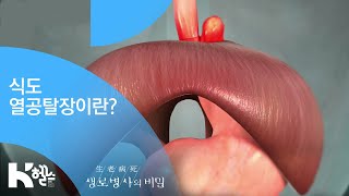 식도열공탈장이란  20181226676회 방송 먹는 행복을 앗아가는 식도질환 [upl. by Luedtke]