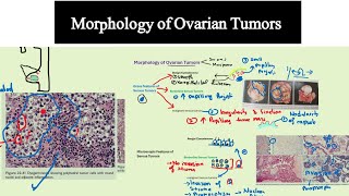 Morphology of Ovarian Tumors Special Pathology DrMUsman [upl. by Tiga24]