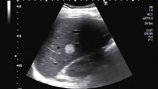 Ultrasound Video showing hemangioma in Liver [upl. by Carce]