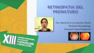 RetinopatiÌa en el prematuro [upl. by Enovad]