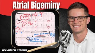 Atrial Bigeminy EKG  ECG Lecture [upl. by Philana]