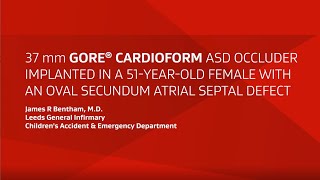 GORE® CARDIOFORM ASD Occluder implant in an oval secundum ASD [upl. by Moneta]