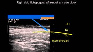 Ultrasound guided right side ilioinguinaliliohypogastric nerve block [upl. by Ahs]