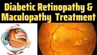 Diabetic Retinopathy Optos  Drss Eye  Diabetic Retinopathy Treatment  Maculopathy Treatment [upl. by Sesylu]