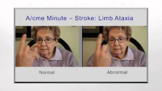 Stroke limb ataxia [upl. by Nodrog977]