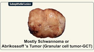 Mostly Schwannoma or Abrikossoff s Tumor Granular cell tumorGCT [upl. by Qifar]