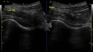 Hip Effusion and POCUS guided arthrocentesis [upl. by Ennaed134]