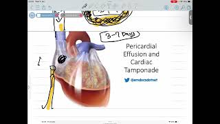 CARDIAC TAMPONADE [upl. by Eolc]