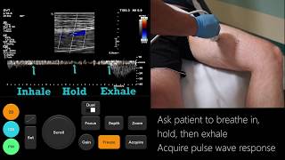 Ultrasound Tutorial DVT  Lower Limb Veins  Radiology Nation [upl. by Leuqer]