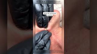 Blackheads on back treatment  Huge blackheads squeezing [upl. by Yojenitsirk]