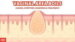 Dealing with Vaginal Area Boils Tips and Advice for Fast Relief [upl. by Maharva]