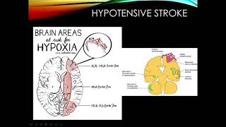 Cerebrovascular Disease Part 2 [upl. by Eirrehs711]