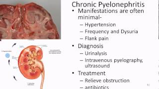 Pathophysiology Renal 3 UTI Acute and Chronic [upl. by Dwayne516]