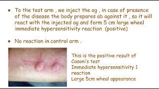 Casoni’s test  hydatid disease  mbbs [upl. by Araihc]