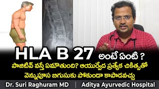 HLA B27  AYURVEDIC TREATMENT  ANKYLOSING SPONDYLITIS [upl. by Duquette]